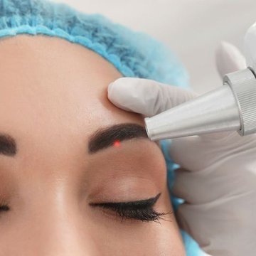 Die Vorteile der PMU-Entfernung mit laser