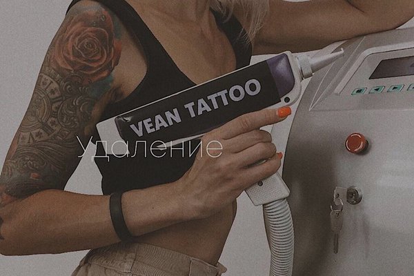 Tatouage Entfernung in Berlin