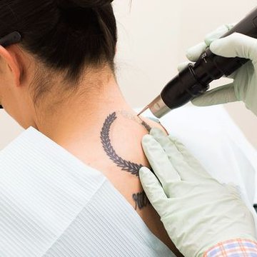 Wie funktioniert Laser Tattoo Entfernung?