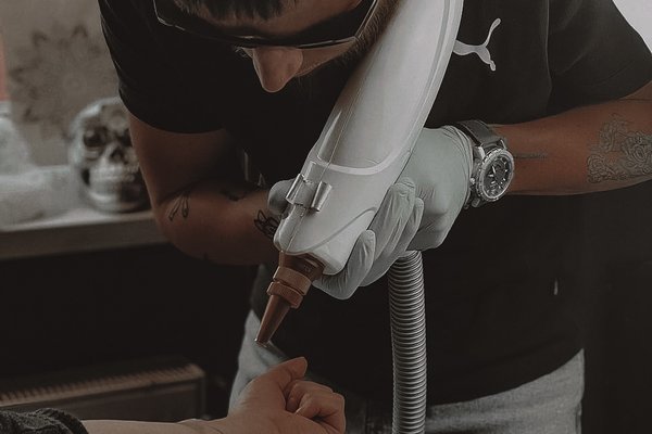 Tattoo Entfernen in Nürnberg