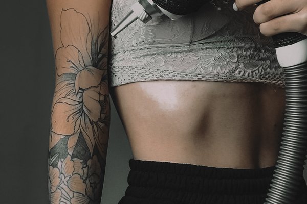 Tattoo Entfernen in Nürnberg