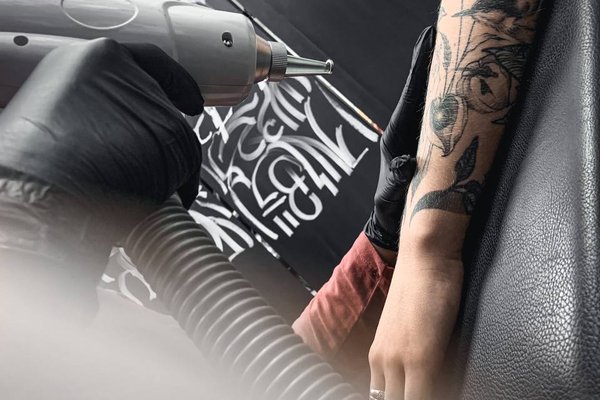 Laser tattoo removal in Frankfurt