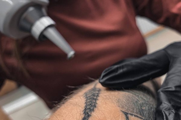 Laser tattoo removal in Frankfurt