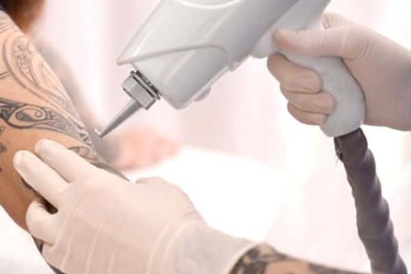 Laser tattoo removal in Frankfurt