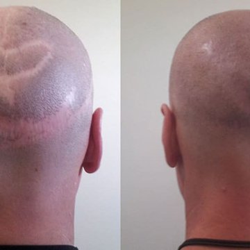 Kann man eine Narbe mit einem Tattoo überdecken
