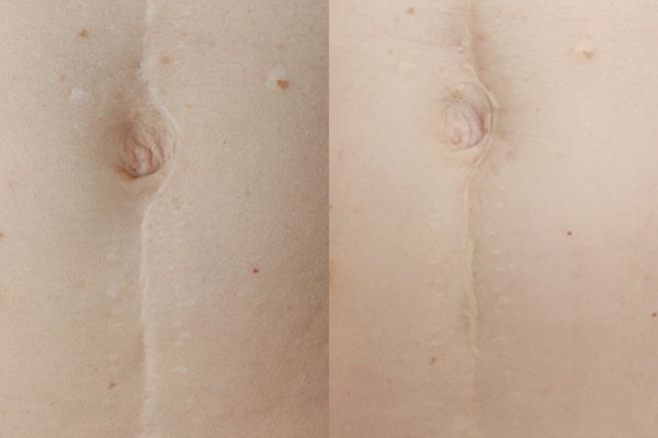 Kann man eine Narbe mit einem Tattoo überdecken
