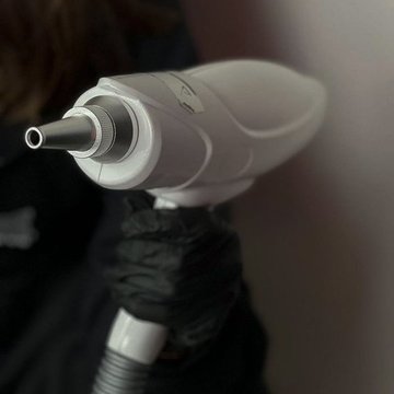 Laser PMU Removal in Frankfurt