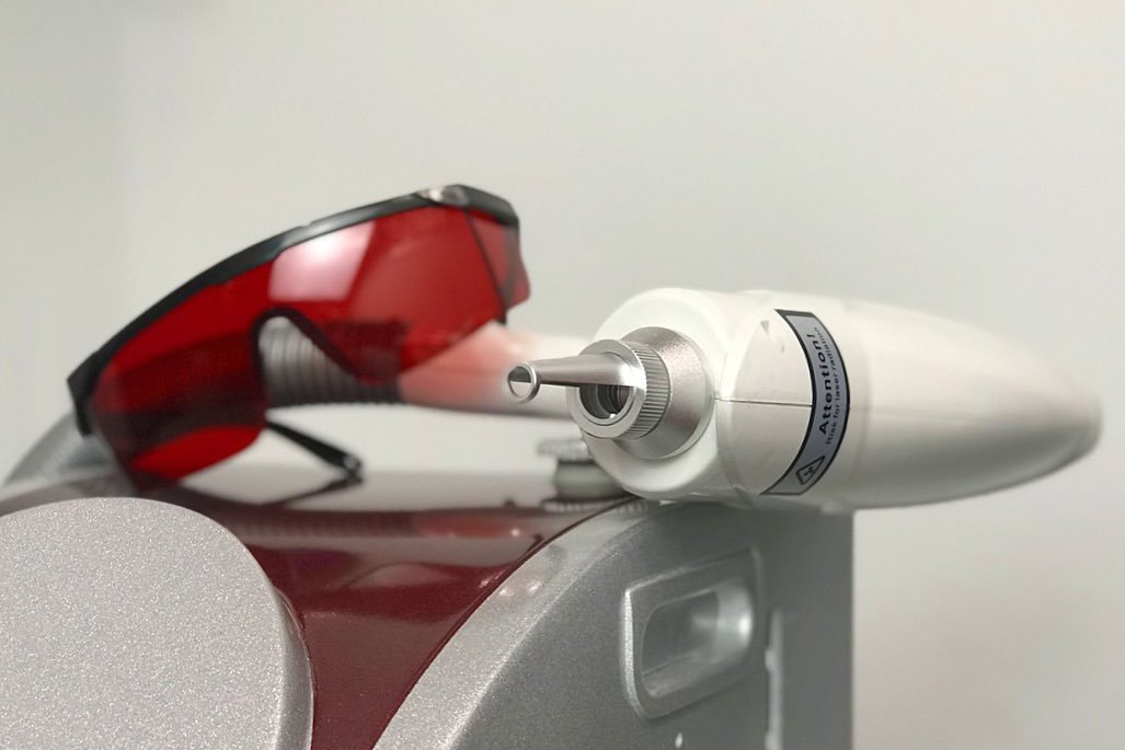 Die Vorteile der PMU-Entfernung mit laser
