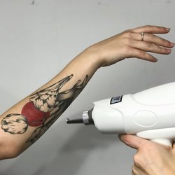 Laser Tattoo Entfernung