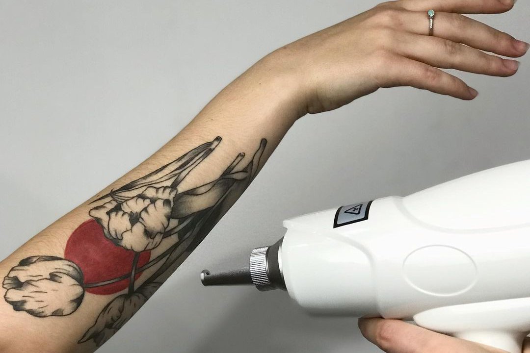 Wie funktioniert Laser Tattoo Entfernung?