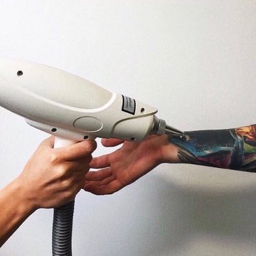 Wie funktioniert Laser Tattoo Entfernung?